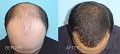 The Hair Restoration Experts